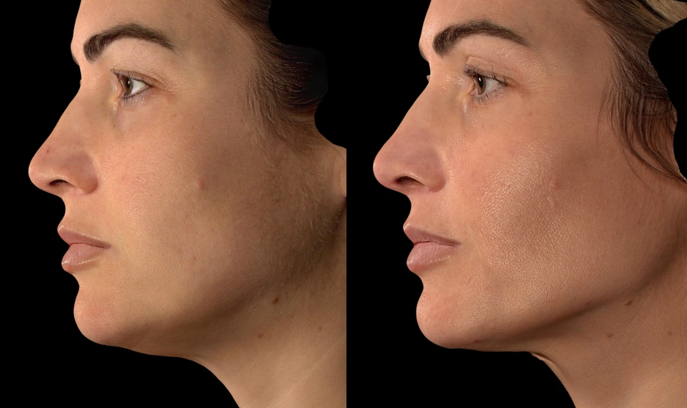 Personalized full-face rejuvenation result, view 4