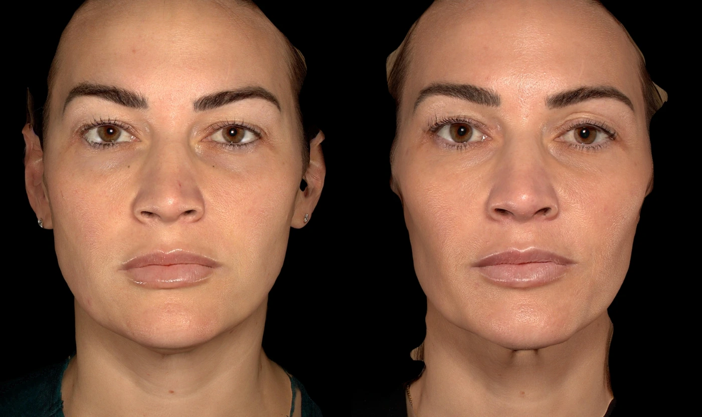Personalized full-face rejuvenation result, view 5
