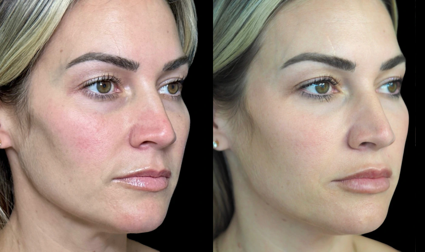 Sculptra and skin quality treatment plan result, view 2