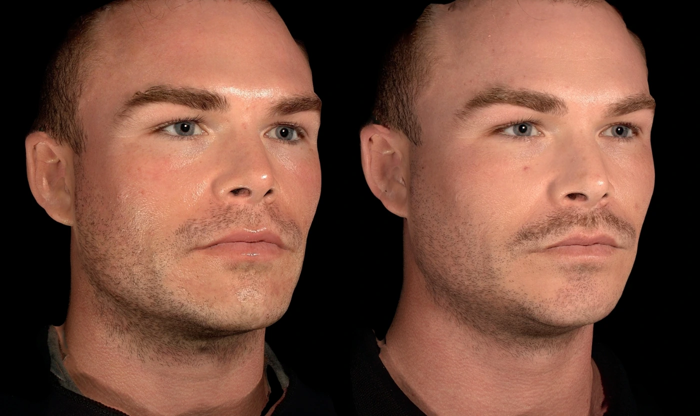 Facial balancing with dermal filler result, view 2
