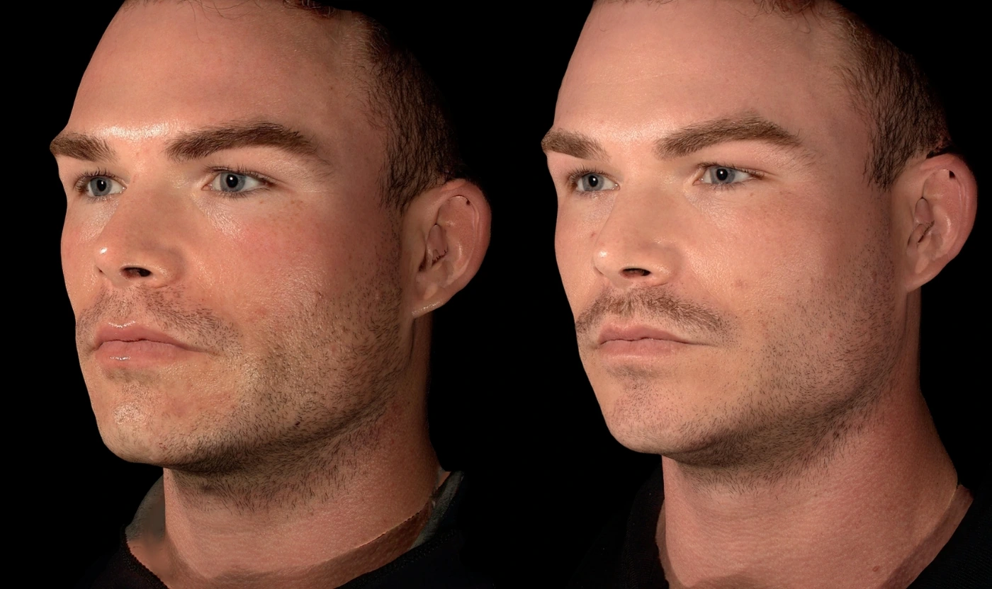 Facial balancing with dermal filler result, view 3