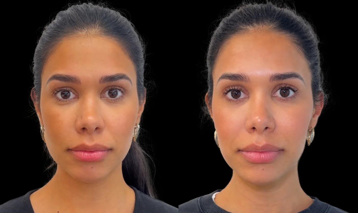Female patient before and after Masseter Botox for facial slimming at SOM Aesthetics