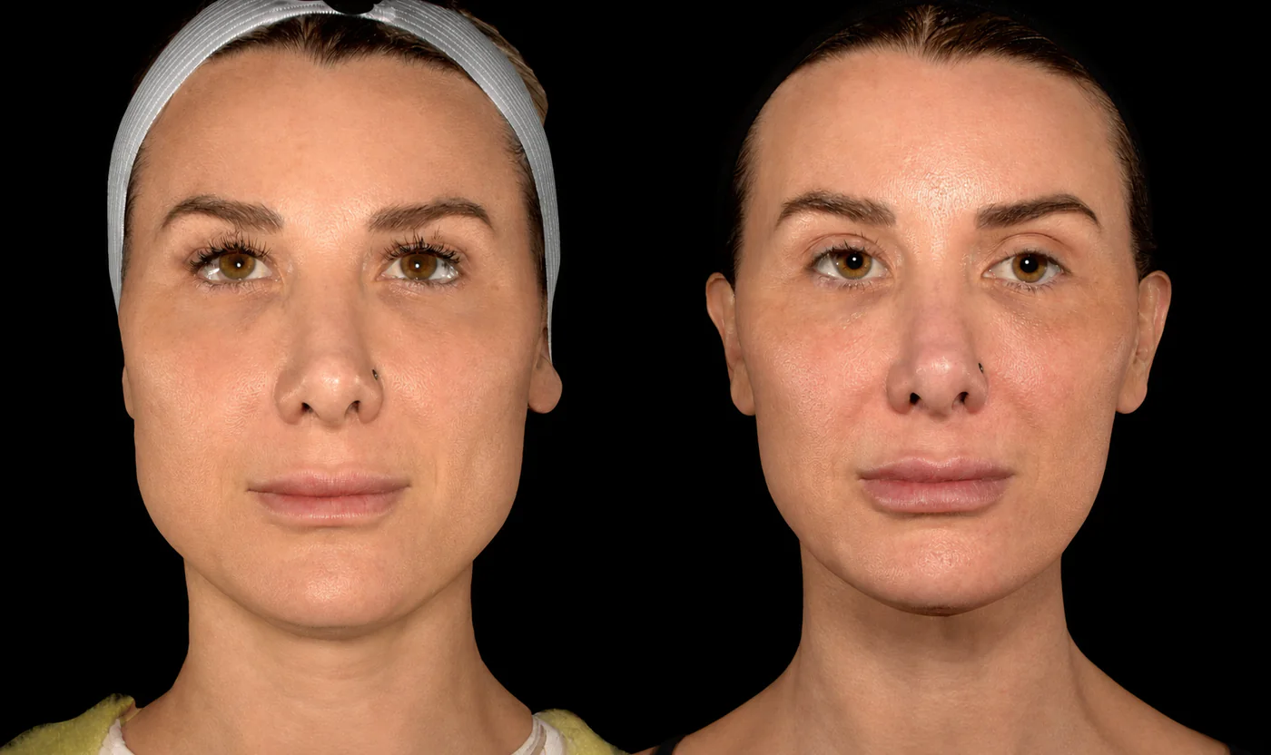 Front view before and after cheek and temple filler with Masseter Botox at SOM Aesthetics