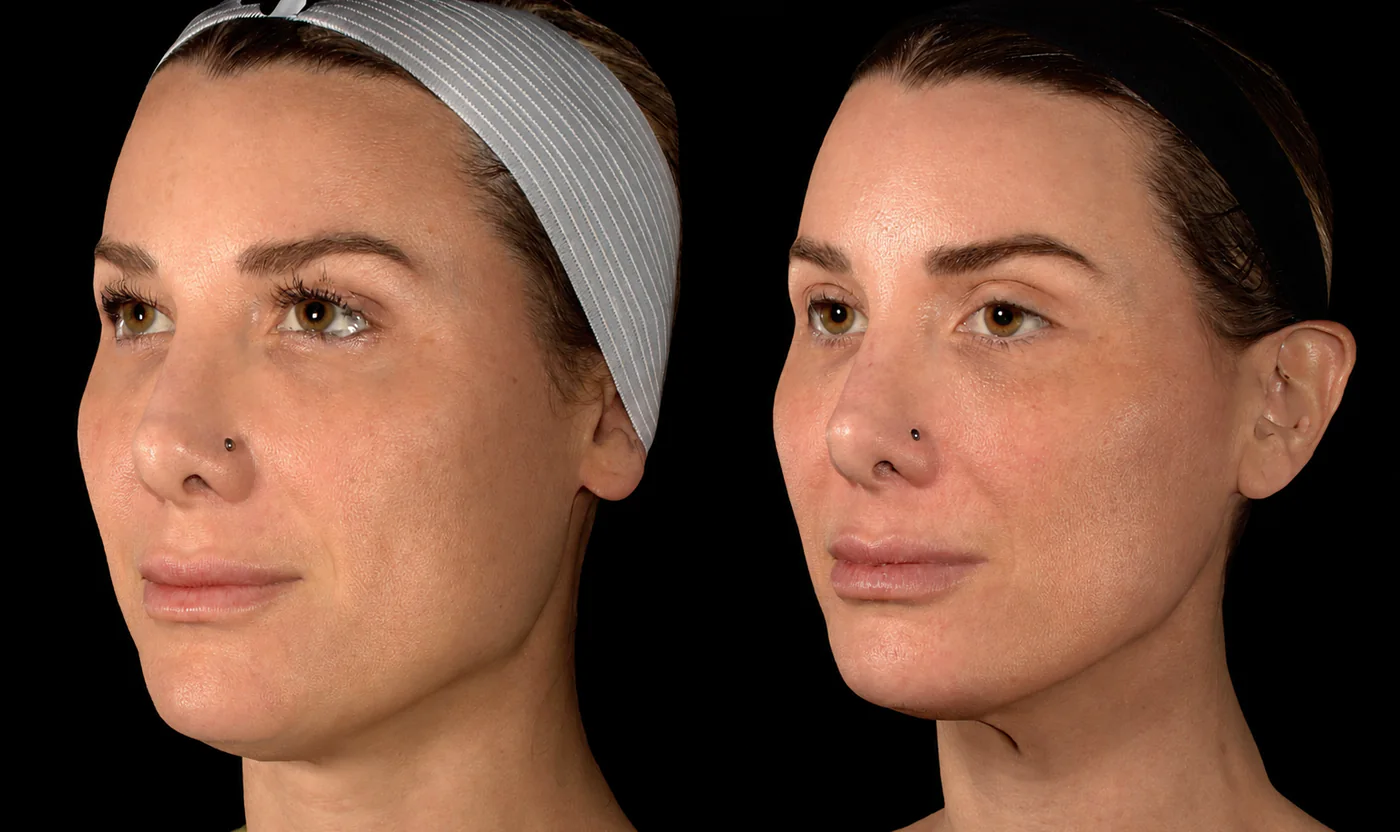 Left profile before and after cheek and temple filler with Masseter Botox at SOM Aesthetics