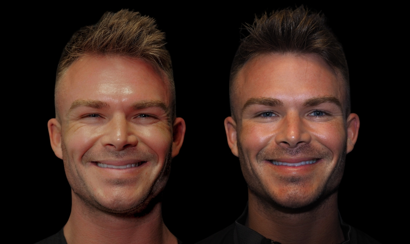 Male patient before and after upper-face Botox at SOM Aesthetics.