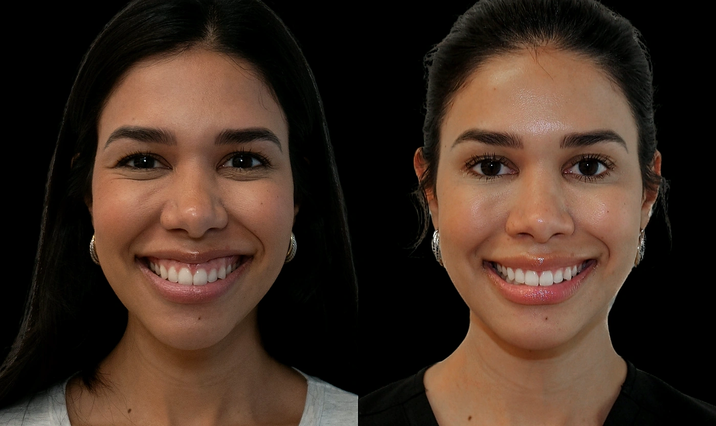 Female patient before and after gummy-smile Botox, shown smiling.