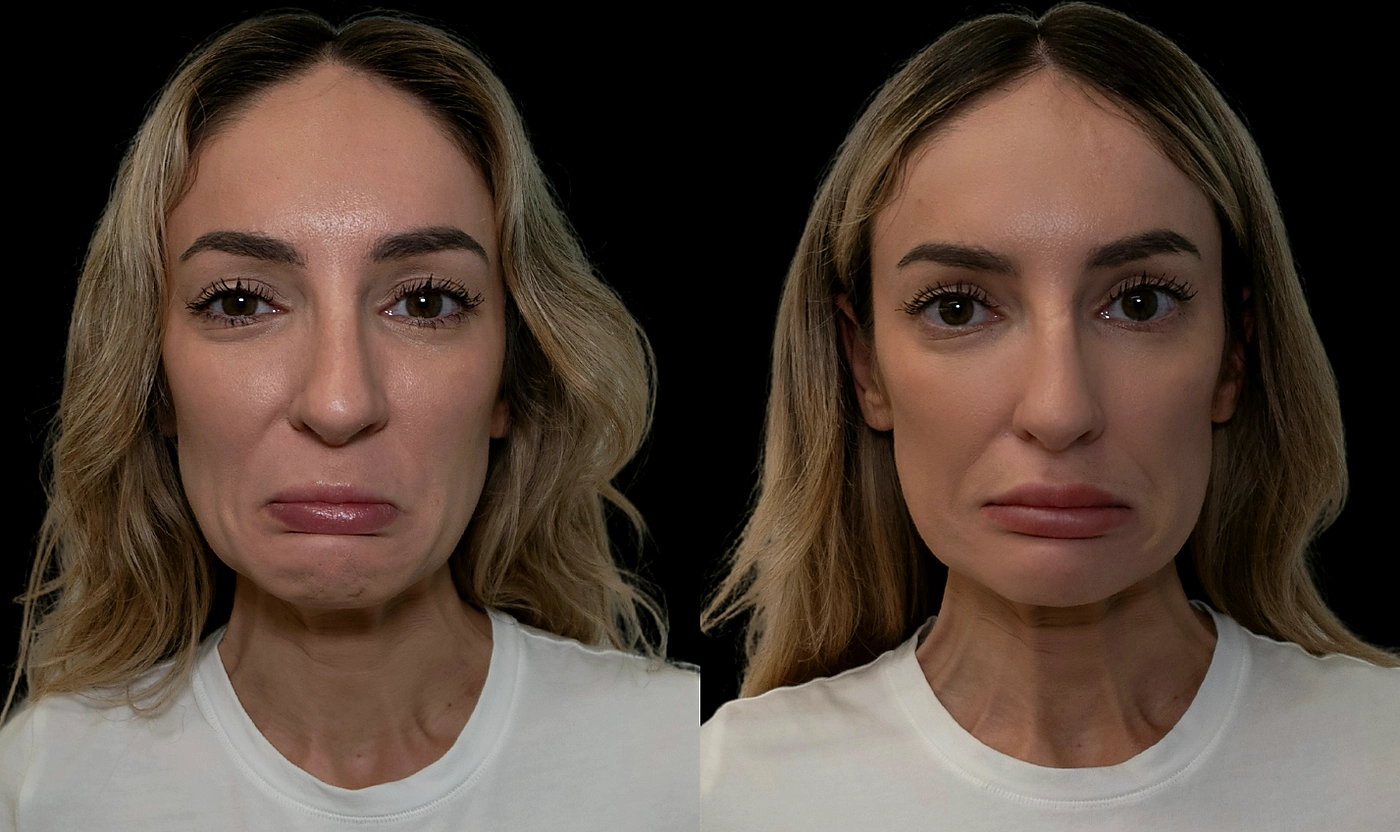 Female patient before and after DAO Botox, shown making a downward-mouth expression.