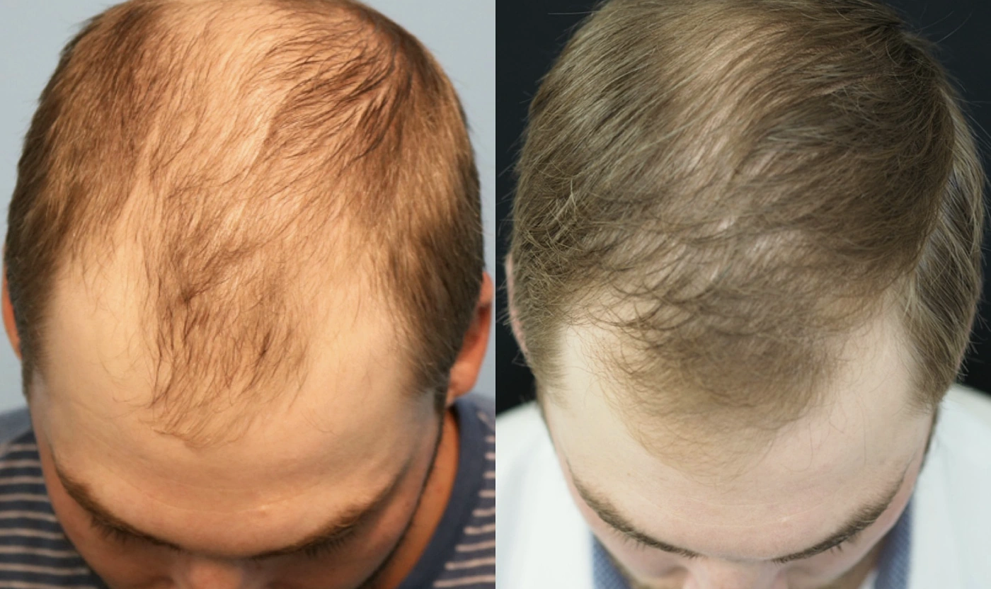 PRP hair restoration before and after result, frontal view