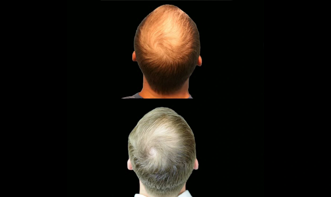 PRP hair restoration before and after result, crown view