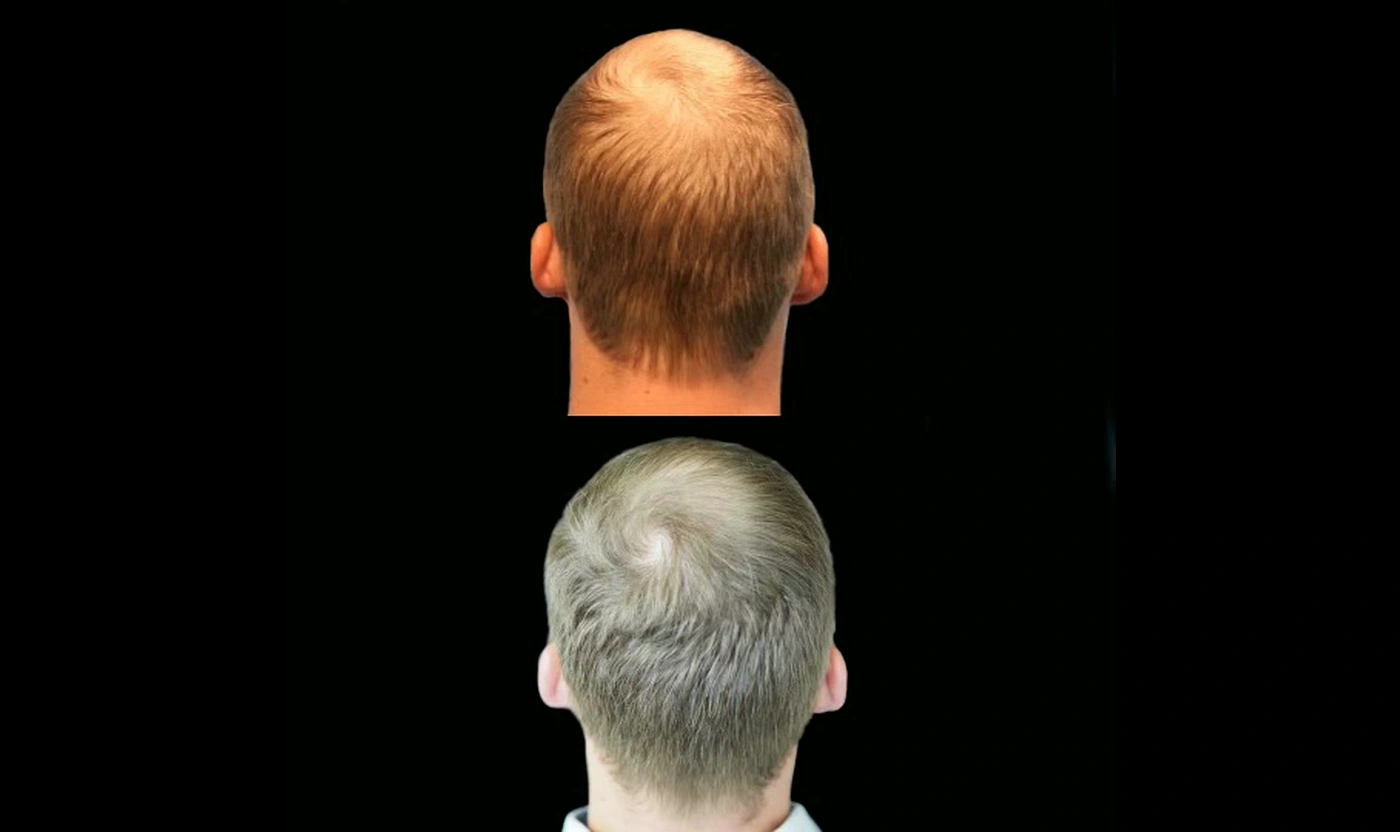 PRP hair restoration before and after result, back crown view