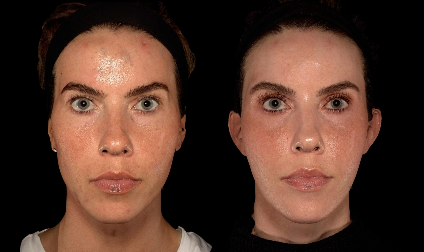 Before and after Renuva, Radiesse, Sculptra and forehead filler combination treatment at SOM Aesthetics in Encinitas, North County San Diego — documented view.