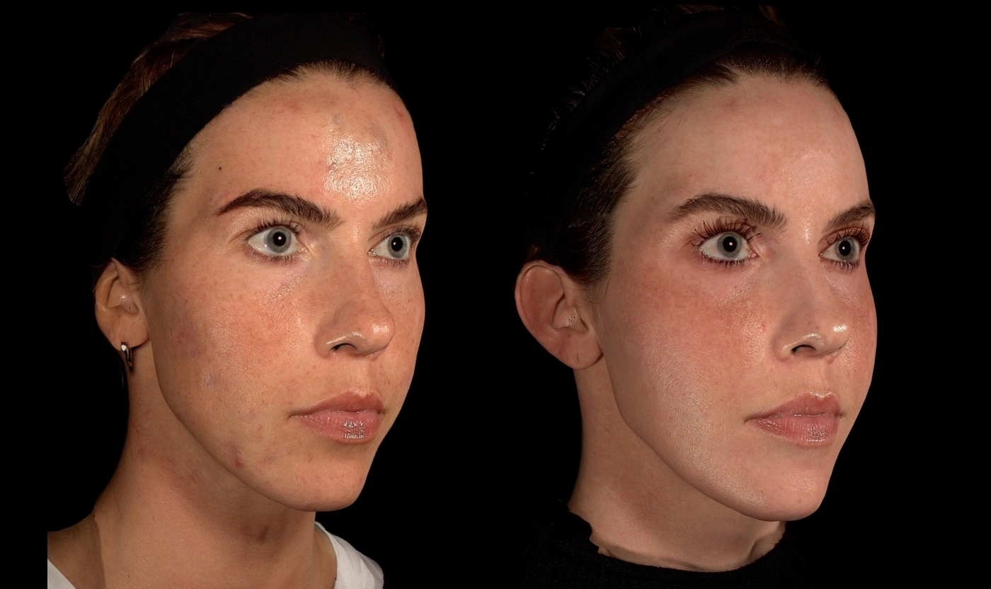 Before and after Renuva, Radiesse, Sculptra and forehead filler combination treatment at SOM Aesthetics in Encinitas, North County San Diego — documented additional view 2.