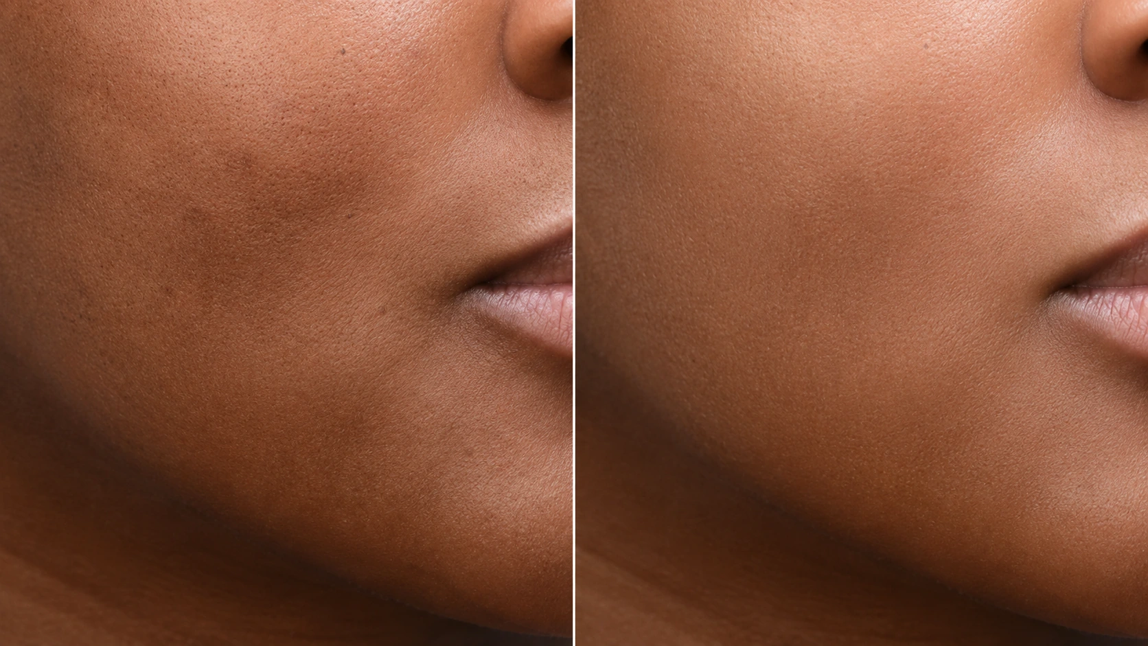 Before-and-after MOXI laser skin treatment result in Encinitas, North County San Diego — documented view.