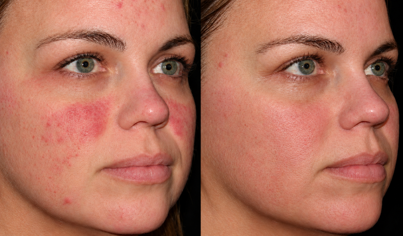 Before-and-after HALO laser skin resurfacing result in Encinitas, North County San Diego — documented view.
