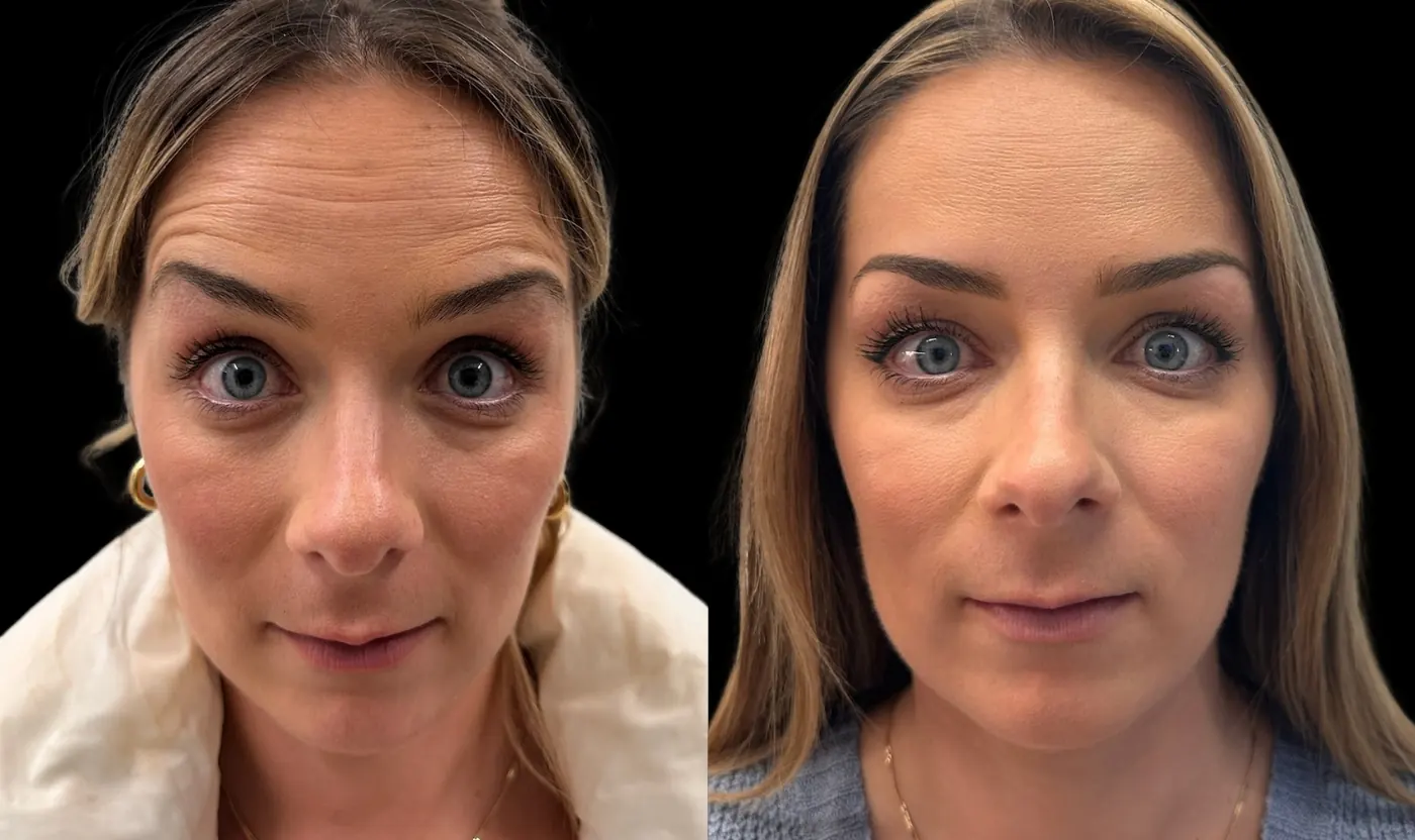 Before-and-after Upper-face Botox for forehead, crow's feet and bunny lines result in Encinitas, North County San Diego — forehead view.