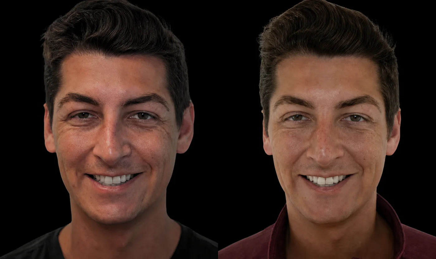 Before-and-after Upper-face Botox result in Encinitas, North County San Diego — crow's-feet view.