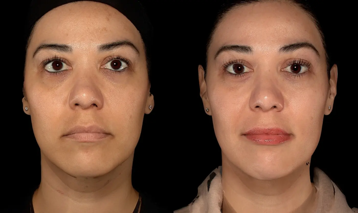 Before-and-after Under-eye and cheek filler facial balancing result in Encinitas, North County San Diego — front view.
