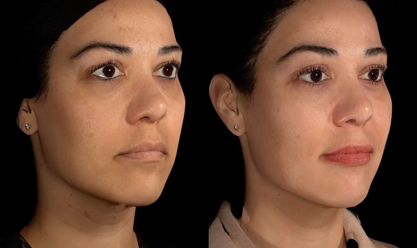 Before-and-after Under-eye and cheek filler facial balancing result in Encinitas, North County San Diego — three-quarter view.