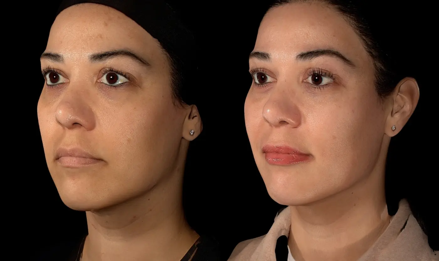 Before-and-after Under-eye and cheek filler facial balancing result in Encinitas, North County San Diego — three-quarter view.