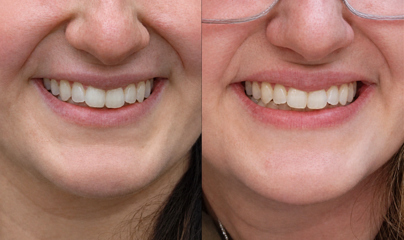 Before-and-after Botox lip flip and lip filler result in Encinitas, North County San Diego — documented view.