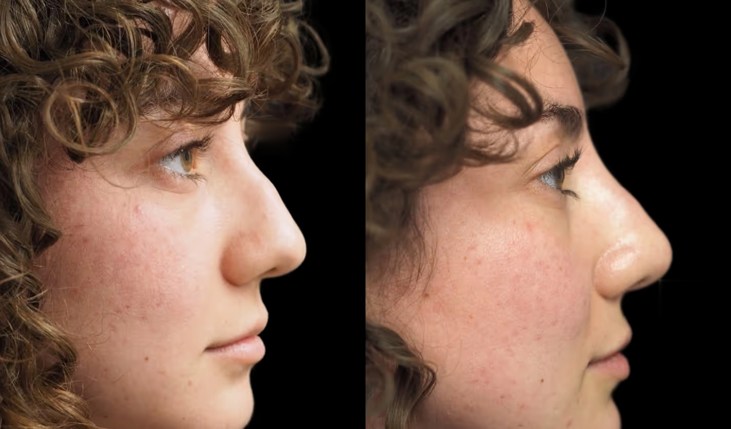 Before-and-after Non-surgical rhinoplasty with nose filler result in Encinitas, North County San Diego — profile view.