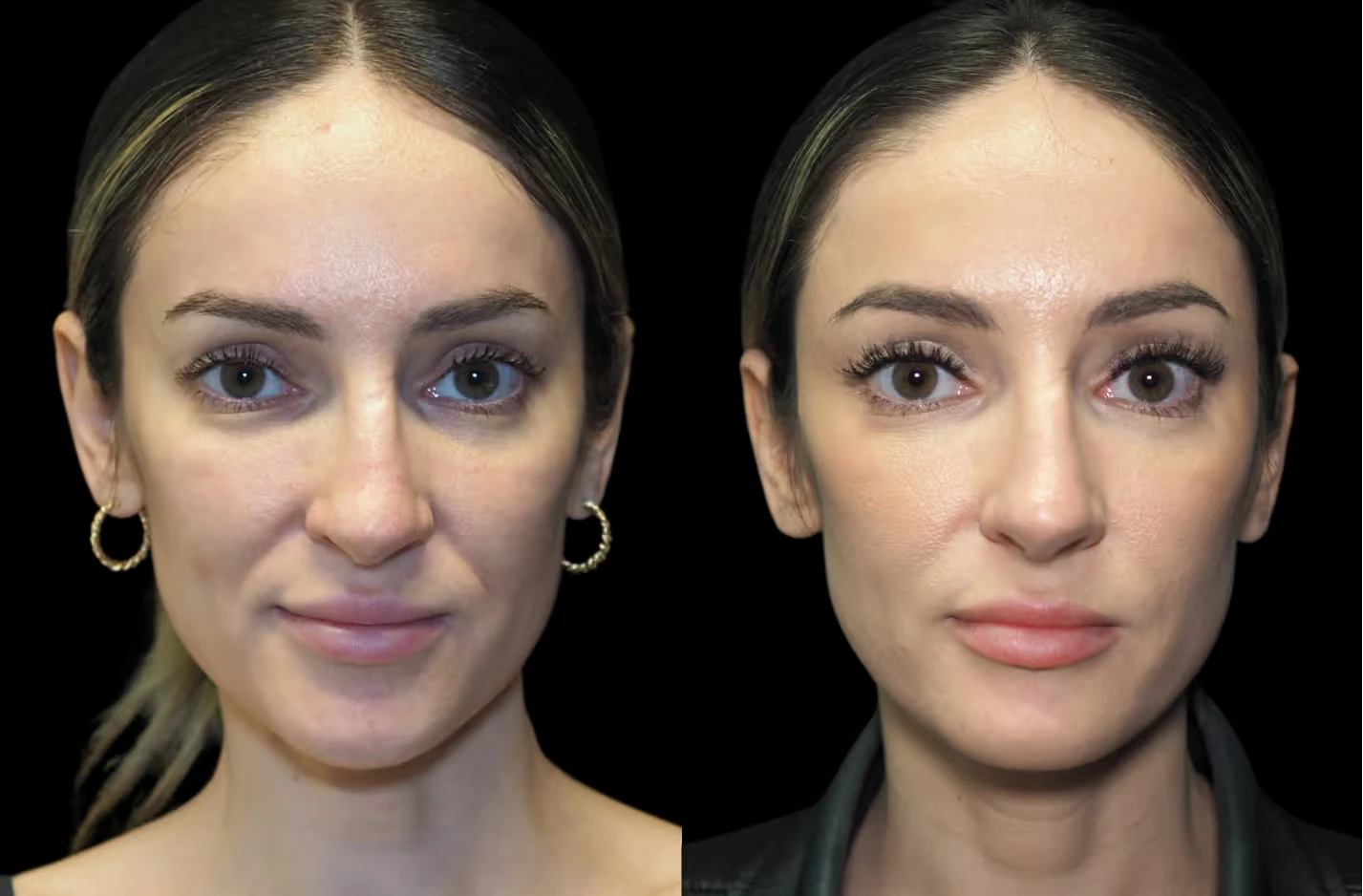 Before-and-after facial balancing with under-eye, cheek and temple filler at SOM Aesthetics in Encinitas, North County San Diego.