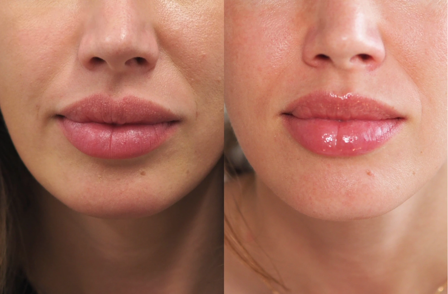 Before-and-after lip filler dissolution result at SOM Aesthetics in Encinitas, North County San Diego — front view.