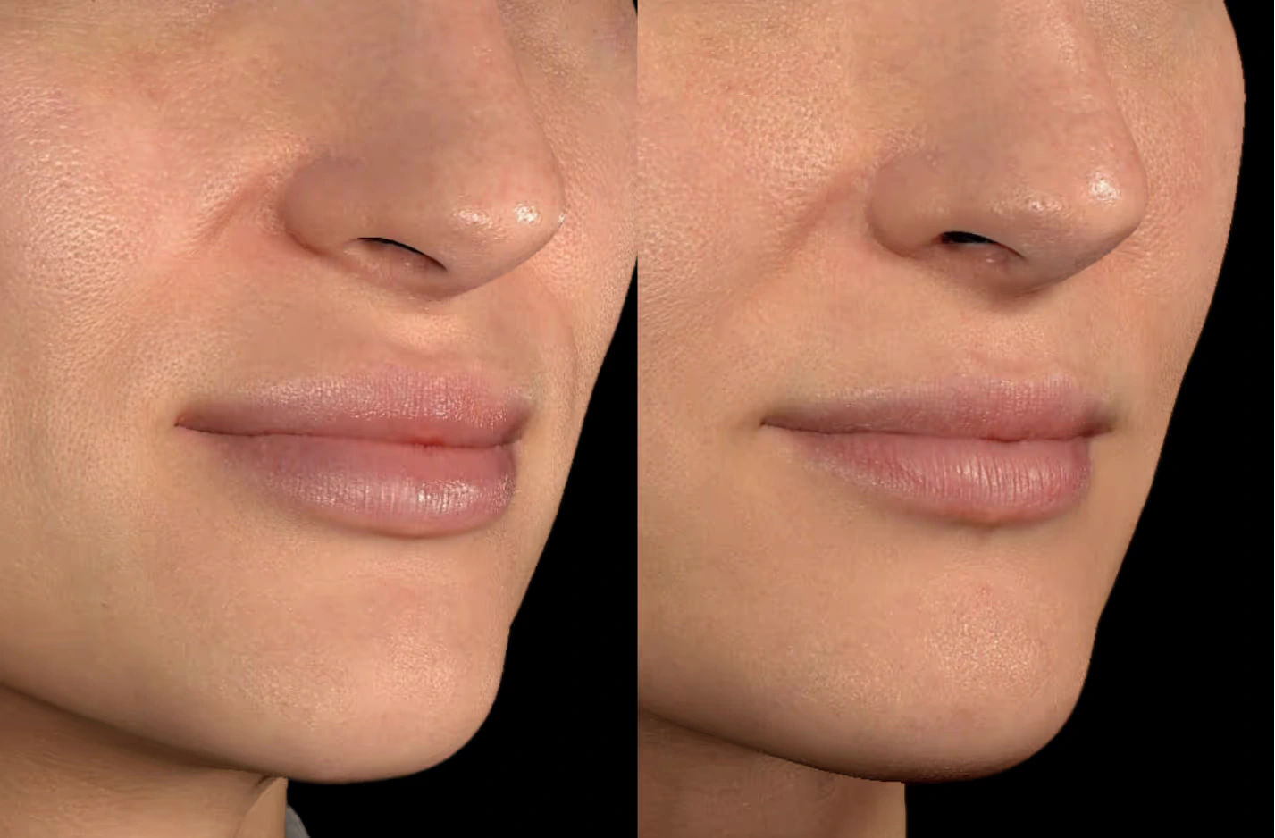 Before-and-after lip filler dissolution at SOM Aesthetics in Encinitas, North County San Diego — three-quarter close-up of the lips.