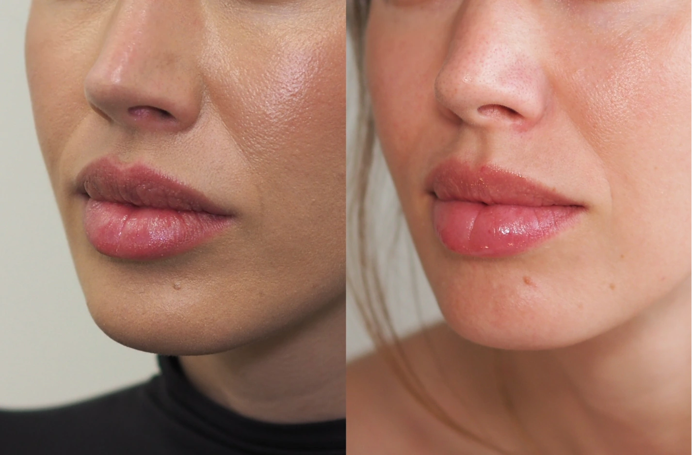Before-and-after lip filler dissolution result at SOM Aesthetics in Encinitas, North County San Diego — three-quarter view.