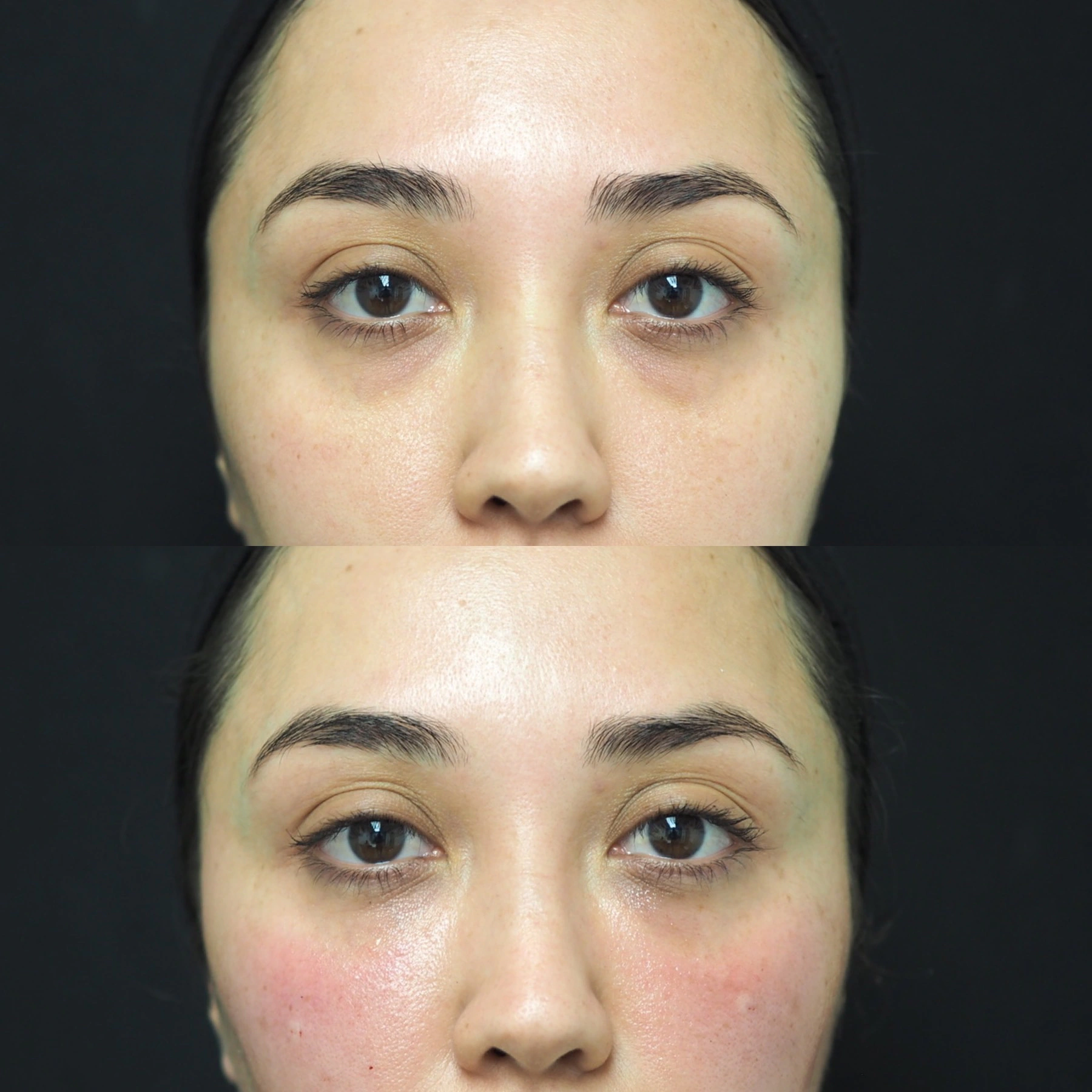 Under-eye tear-trough filler before and after at SOM Aesthetics in Encinitas, San Diego — frontal view, before above and after below.