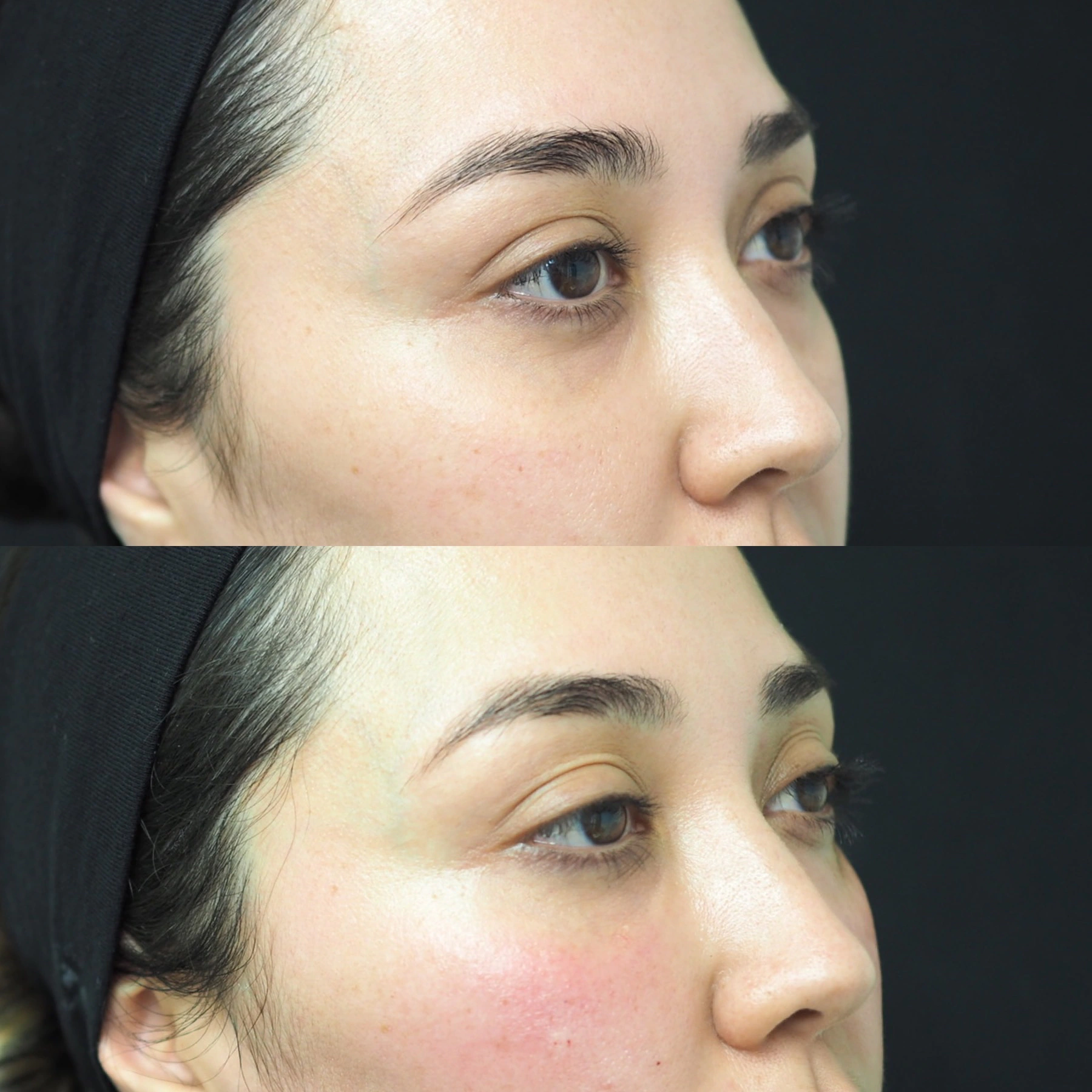 Under-eye tear-trough filler before and after at SOM Aesthetics in Encinitas, San Diego — three-quarter view, before above and after below.