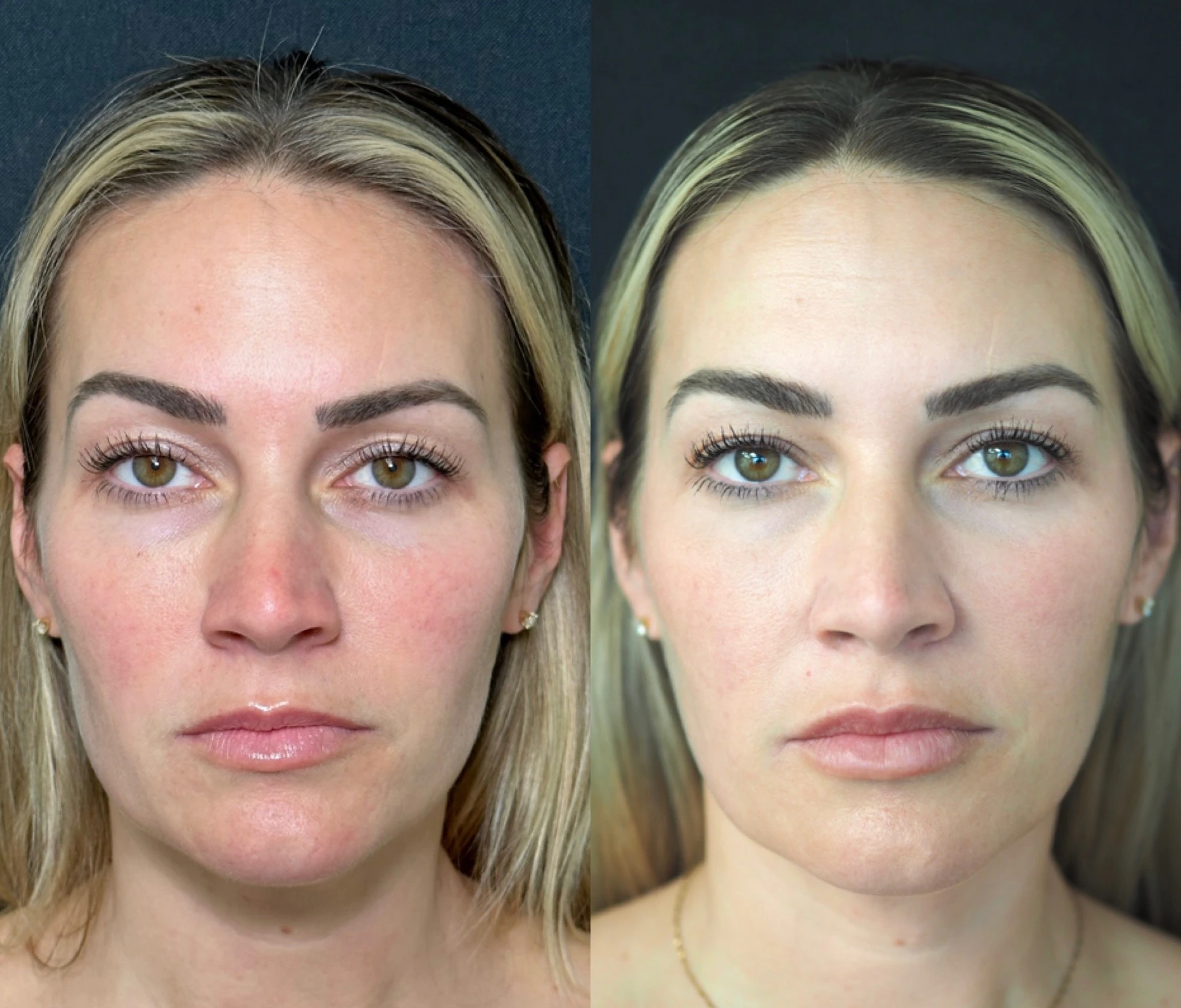 Combined Sculptra, lip and under-eye filler, Sylfirm X, MOXI and BBL before-and-after result at SOM Aesthetics in Encinitas, CA - frontal view.