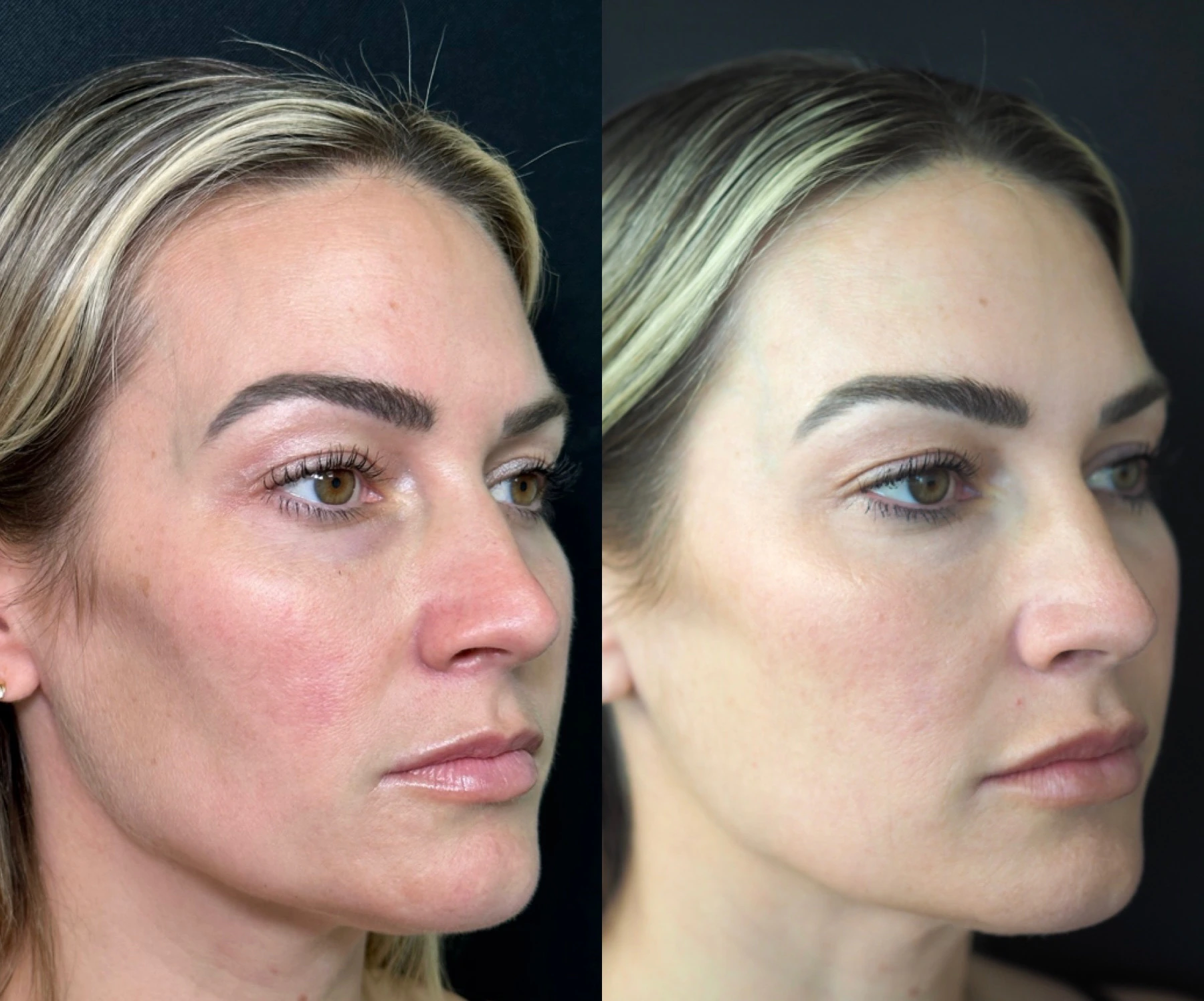 Combined Sculptra, lip and under-eye filler, Sylfirm X, MOXI and BBL before-and-after result at SOM Aesthetics in Encinitas, CA - three-quarter view.