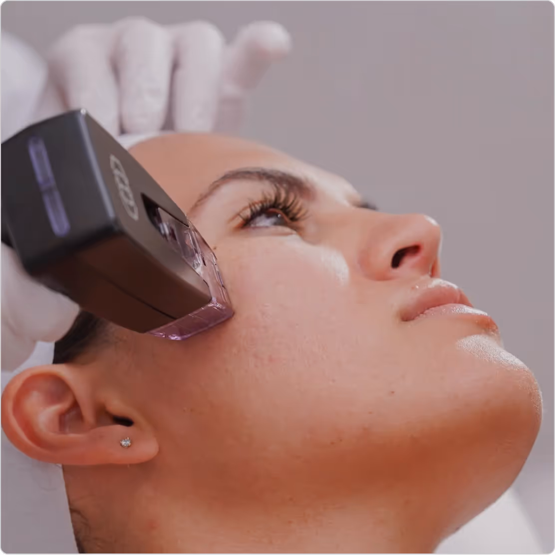 RF Therapy with Morpheus8