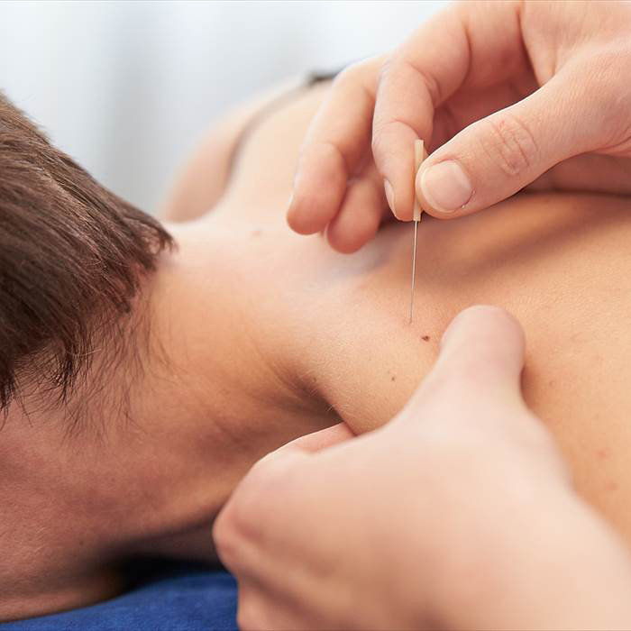 Close-up of dry needling treatment, a hand inserting a needle into a person's shoulder muscle.