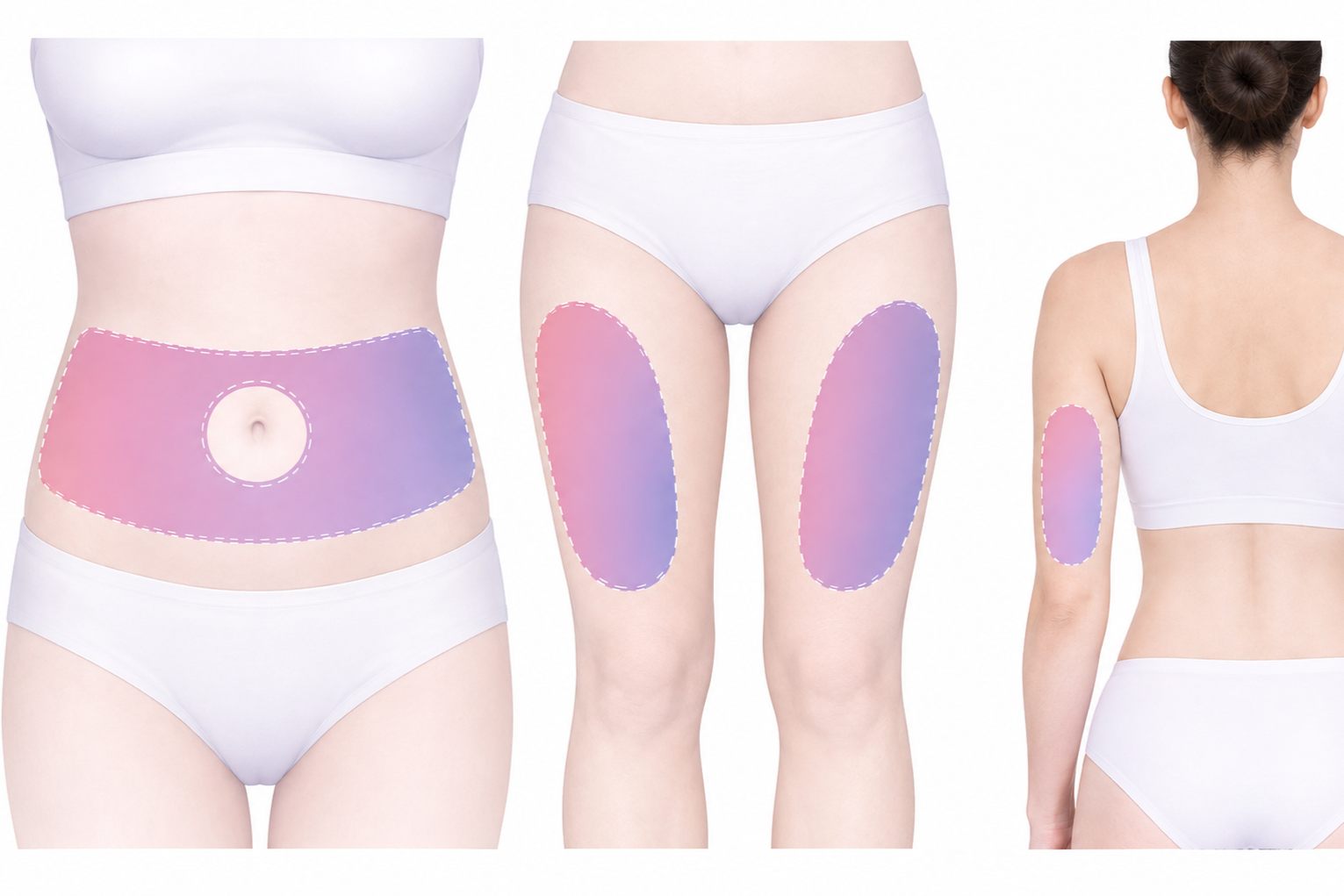 Diagram of a female body showing recommended subcutaneous injection sites for Mounjaro.
