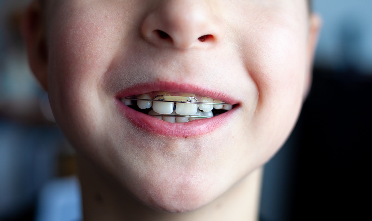 Diastema – Co to jest i jak leczyć? OrthoVision Lublin