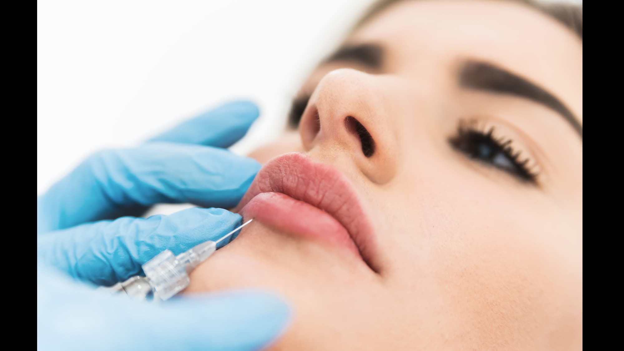 Cosmetic Dermal Fillers for Volume Restoration & Wrinkle Reduction