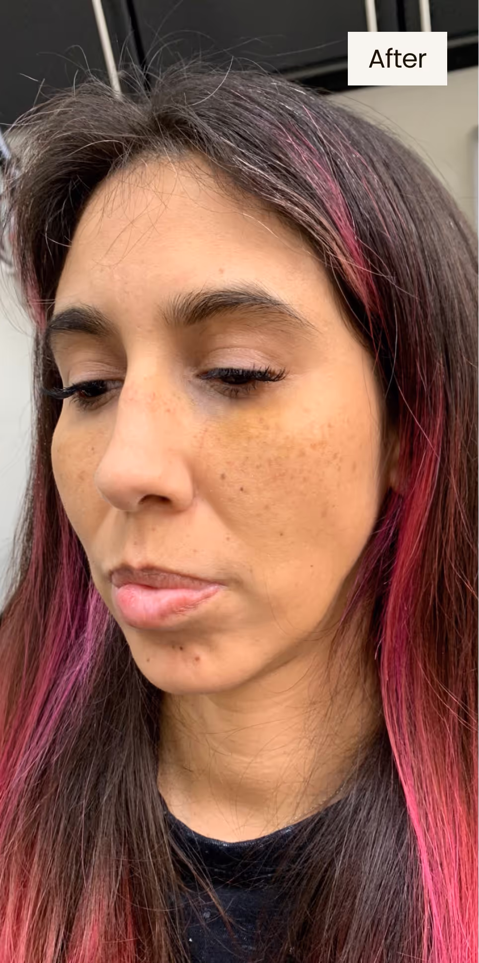 after procedure image