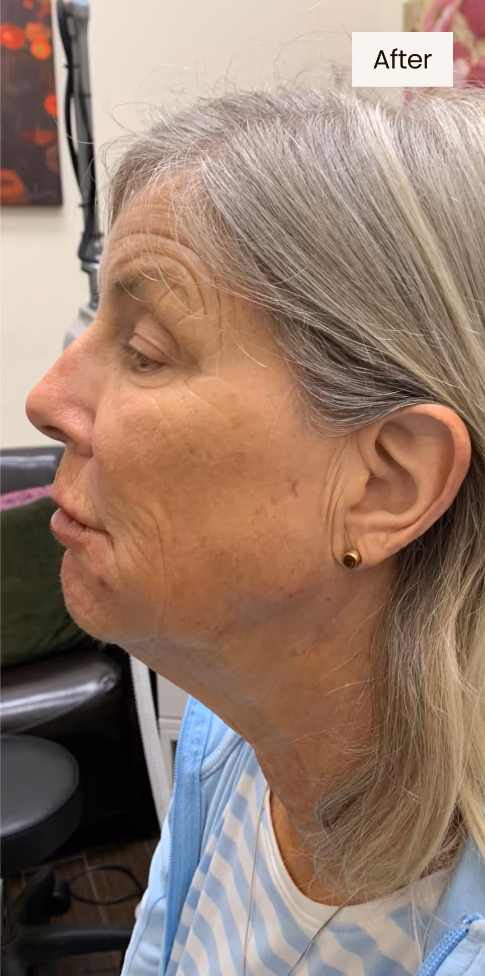 after procedure image
