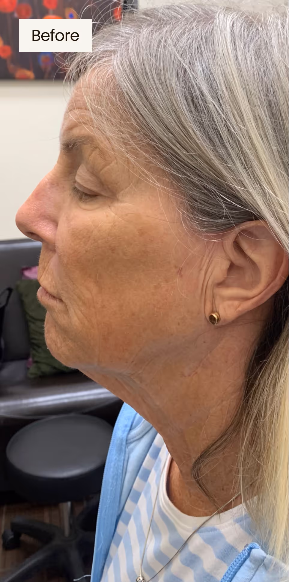 before procedure image