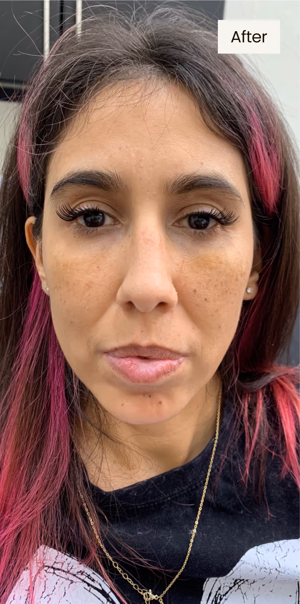 after procedure image