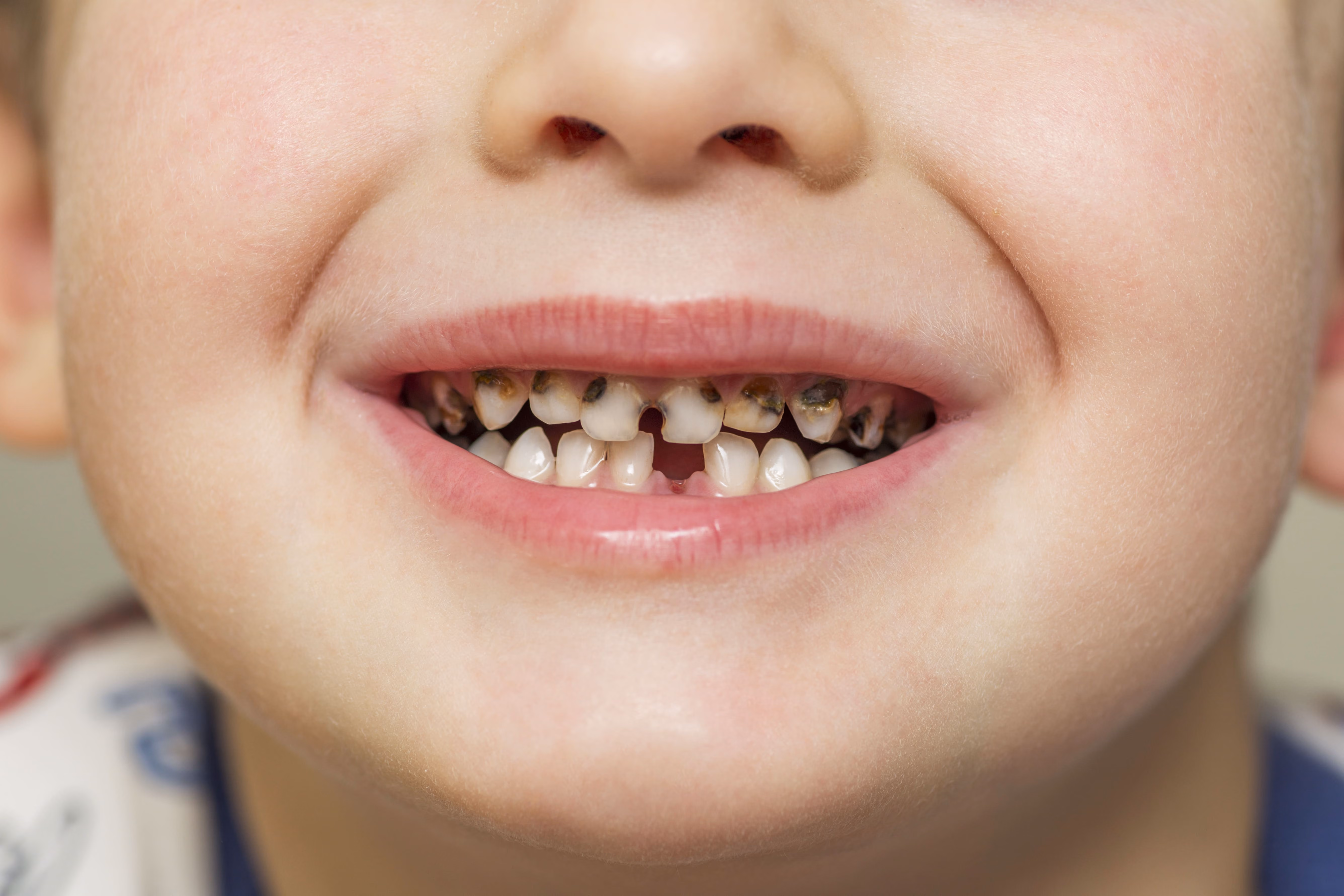 What Brown Lines on Baby Teeth Indicate