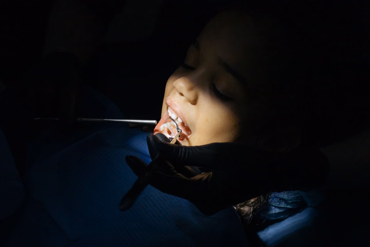 Do Milk Teeth Need Fillings Before They Fall Out