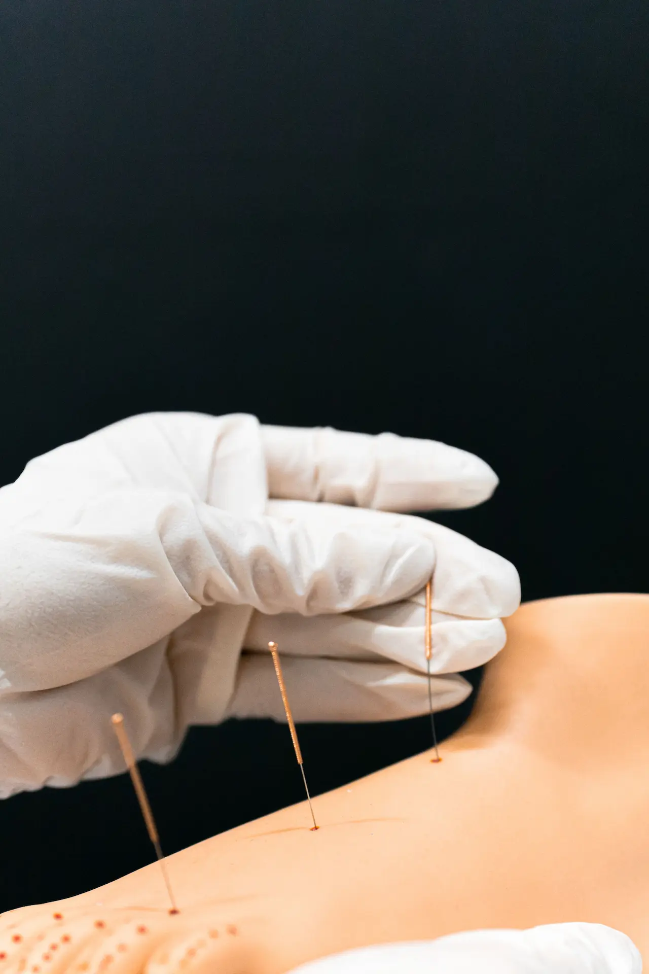What Is Dry Needling?