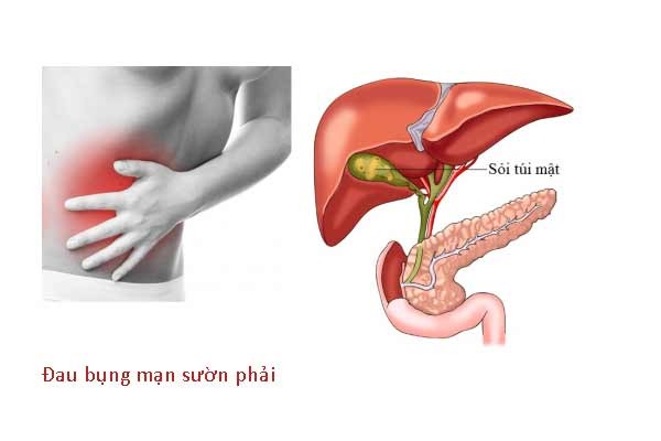 Dấu hiệu nhận biết các loại đau bụng do sỏi mật