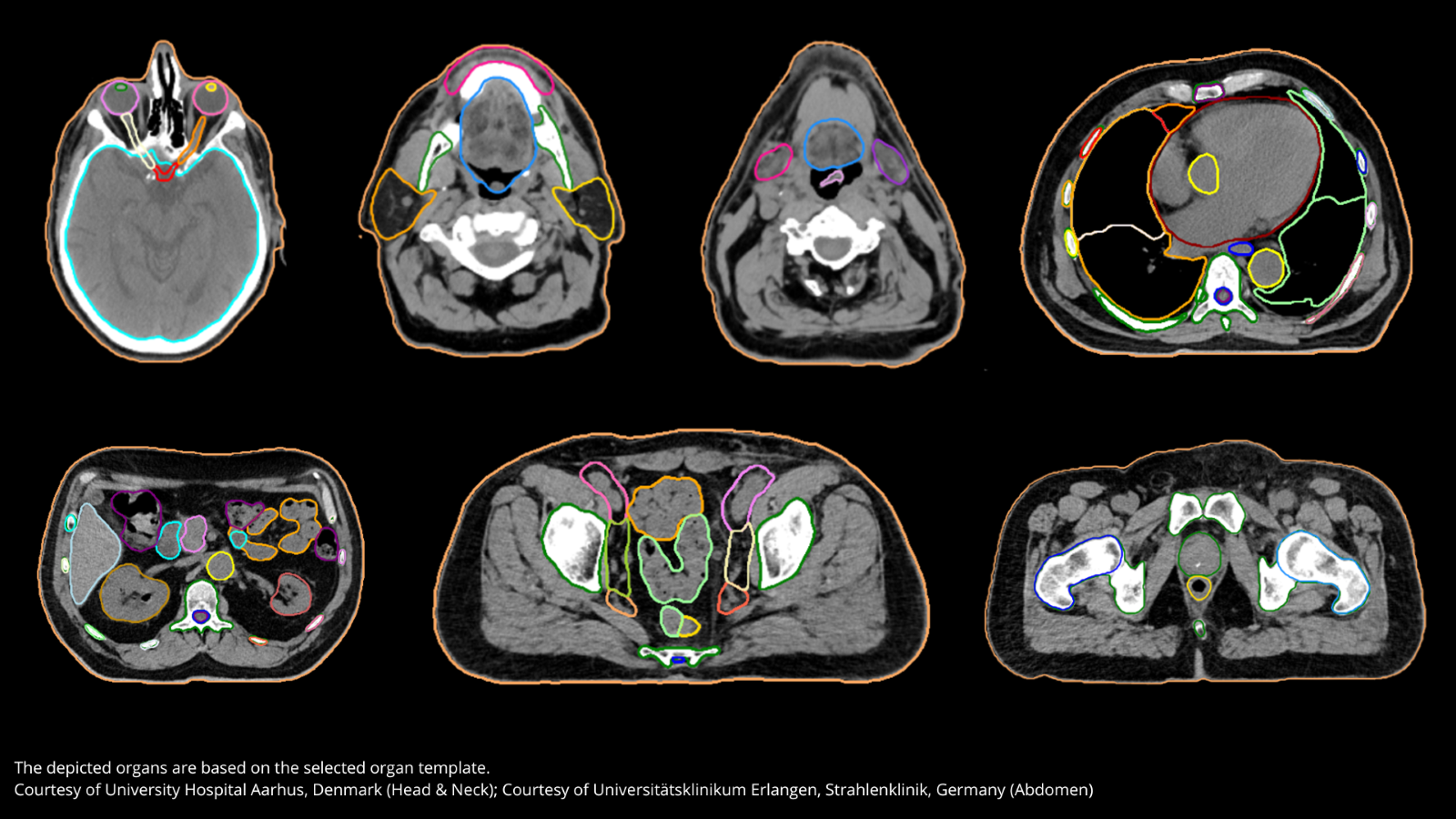 AI ten dienste van radiotherapie in Kliniek Sint-Jan
