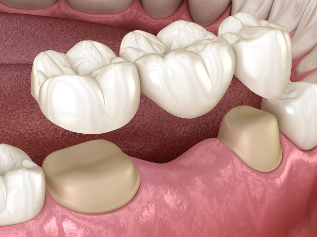 What are Dental Bridges?