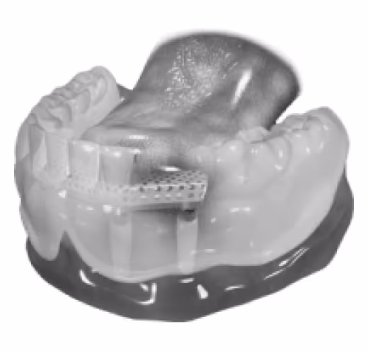 proteza-na-implantach-z-belka-szczecin