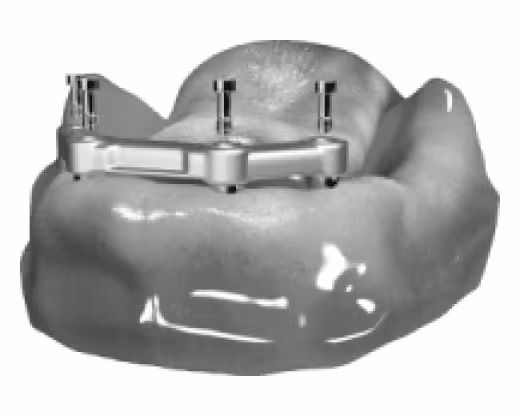 protezy-na-implantach-z-belka